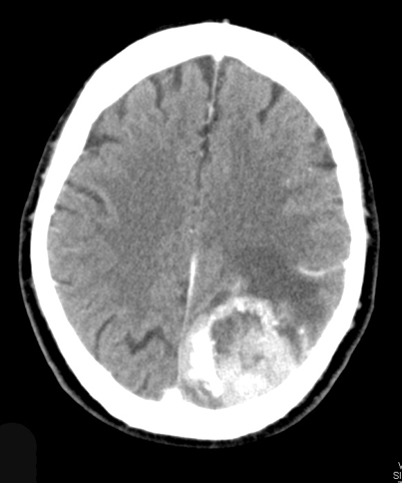 13A Meningioma, anaplastic (Case 13) CT 2 - Copy