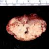 13B Meningioma, anaplastic (Case 13) Gross