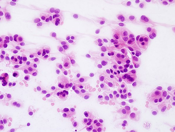 13C1 Meningioma, anaplastic (Case 13) H&E smear 2.jpg