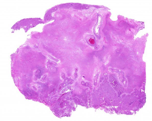 13C2 Meningioma, anaplastic (Case 13) H&E whole mount 2