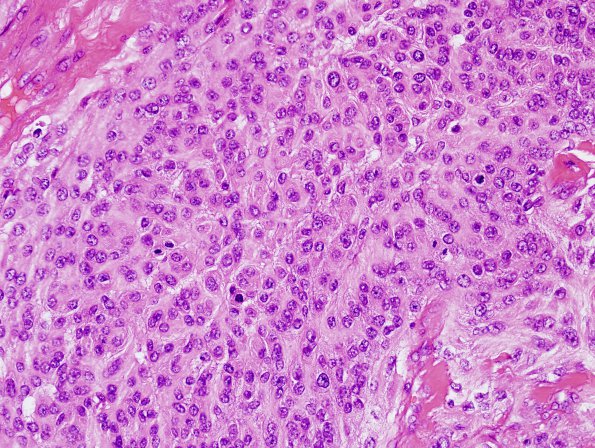 13C3 Meningioma, anaplastic (Case 13) H&E 5.jpg