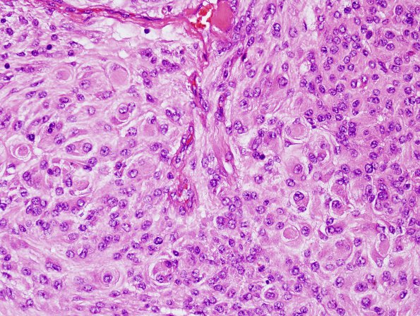 13C4 Meningioma, anaplastic (Case 13) H&E 6.jpg