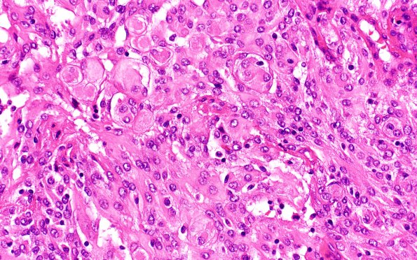 13C6 Meningioma, anaplastic (Case 13) H&E 40X