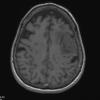 14A1 Meningioma, anaplastic (Case 14) T1 1 - Copy