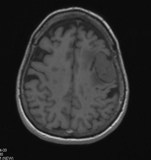 14A1 Meningioma, anaplastic (Case 14) T1 1 - Copy