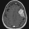 14A2 Meningioma, anaplastic (Case 14) T1 W 1 - Copy