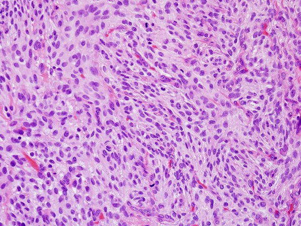 14B1 Meningioma, anaplastic (Case 14) H&E 5.jpg