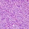 14B2 Meningioma, anaplastic (Case 14) H&E 4.jpg