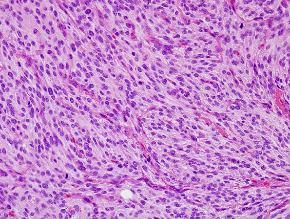 14B2 Meningioma, anaplastic (Case 14) H&E 4.jpg