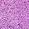 14B3 Meningioma, anaplastic (Case 14) H&E 6.jpg