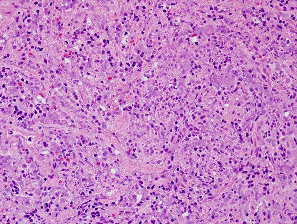 14B3 Meningioma, anaplastic (Case 14) H&E 6.jpg