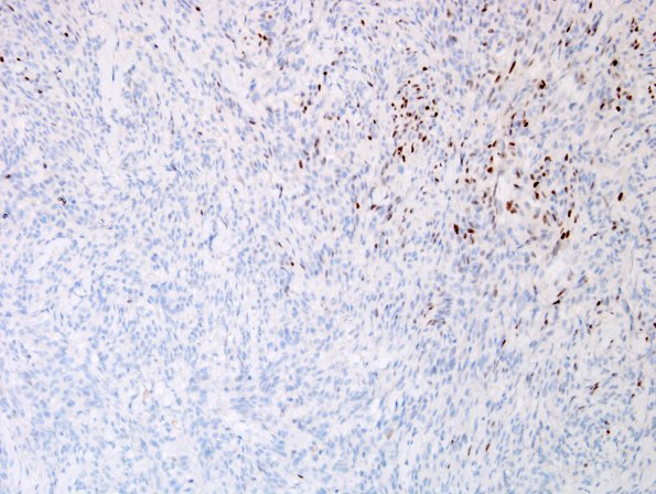 14C2 Meningioma, anaplastic (Case 14) PR 1.jpg