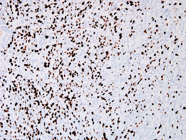 14D Meningioma, anaplastic (Case 14) Ki67 1.jpg