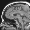 15A1 Meningioma, anaplastic (Case 15) MPRANGE - Copy