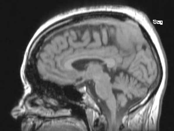 15A1 Meningioma, anaplastic (Case 15) MPRANGE - Copy