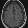 15A2 Meningioma, anaplastic (Case 15) T1 1 - Copy