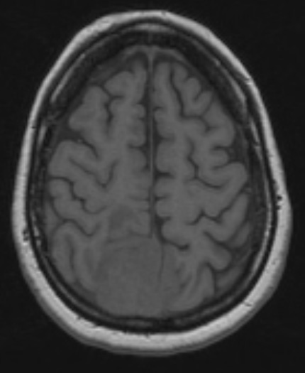 15A2 Meningioma, anaplastic (Case 15) T1 1 - Copy