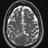 15A3 Meningioma, anaplastic (Case 15) T2 W 1 - Copy