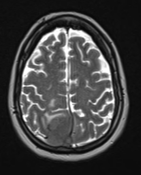 15A3 Meningioma, anaplastic (Case 15) T2 W 1 - Copy