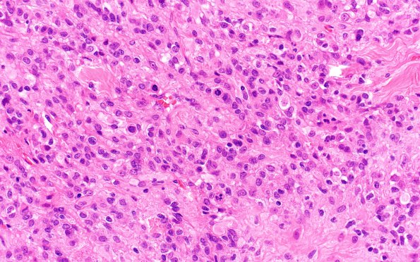 15B2 Meningioma, anaplastic (Case 15) H&E 40X 2