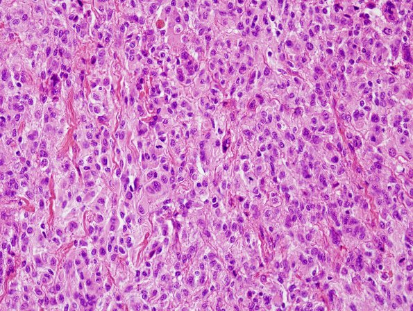 15B3 Meningioma, anaplastic (Case 15) H&E 1.jpg