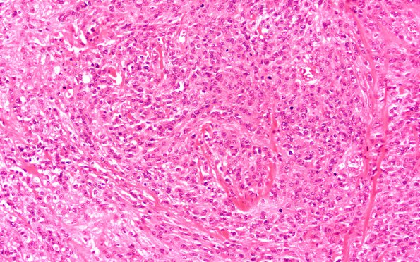 16A1 Meningioma, Anaplastic (Case 16) H&E 40X 2