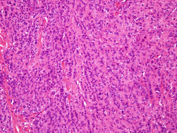 16A2 Meningioma, Anaplastic (Case 16) H&E3