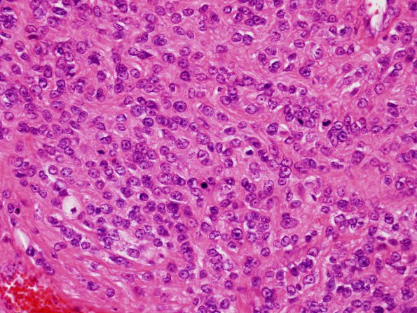 16A3 Meningioma, Anaplastic (Case 16) H&E4