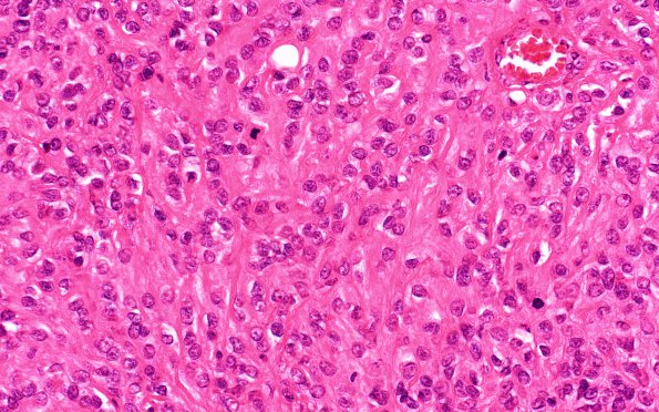 16A4 Meningioma, Anaplastic (Case 16) H&E 40X 1