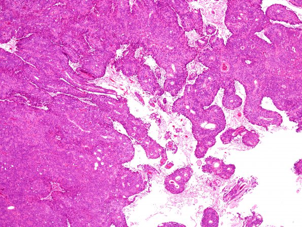 16A5 Meningioma, Anaplastic (Case 16) H&E 1