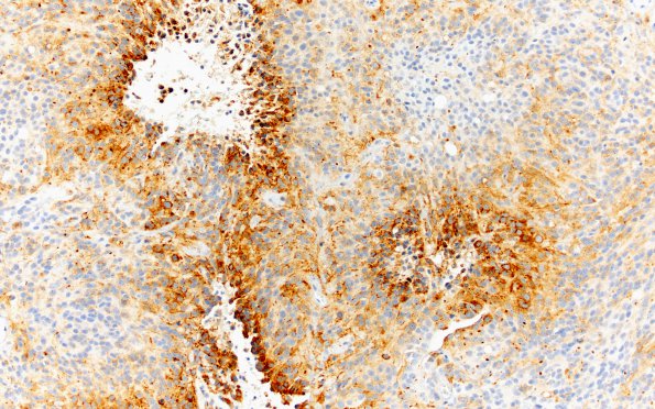 16B1 Meningioma, Anaplastic (Case 16) EMA 20X 1