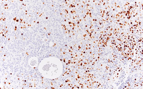 16C Meningioma, Anaplastic (Case 16) Ki67 40X 1