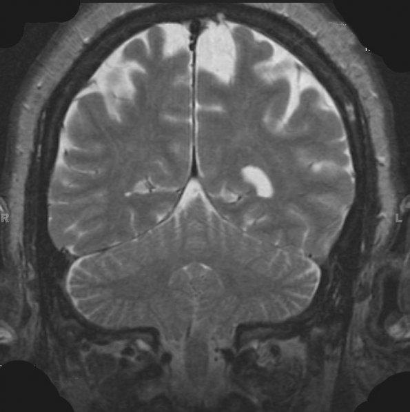 17A Meningioma, anaplastic (Case 17) T2 - Copy