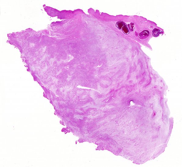 17B1 Meningioma, anaplastic (sarcomatoid) (Case 17) 1 H&E WM A