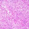 17B2r Meningioma, anaplastic (sarcomatoid) (Case 17) H&E 9.jpg