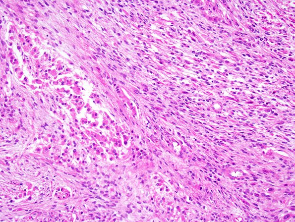 17B2r Meningioma, anaplastic (sarcomatoid) (Case 17) H&E 9.jpg