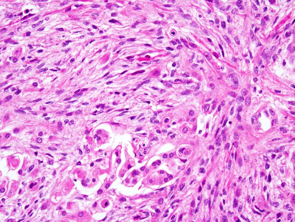 17B3r Meningioma, anaplastic (sarcomatoid) (Case 17) H&E 13.jpg