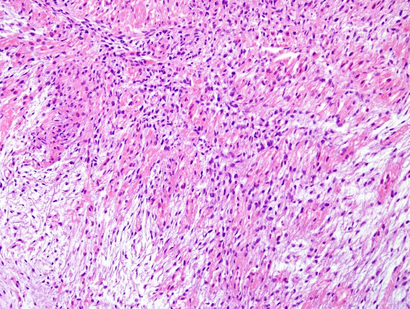 17B4r Meningioma, anaplastic (sarcomatoid) (Case 17) H&E 3