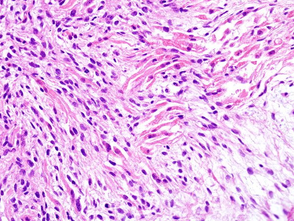 17B5r Meningioma, anaplastic (sarcomatoid) (Case 17) H&E 1