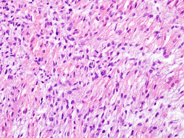 17B6 Meningioma, anaplastic (sarcomatoid) (Case 17) H&E 4