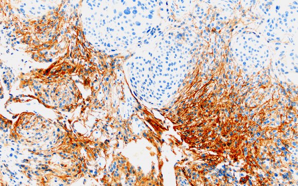 17C Meningioma, anaplastic (sarcomatoid) (Case 17) EMA