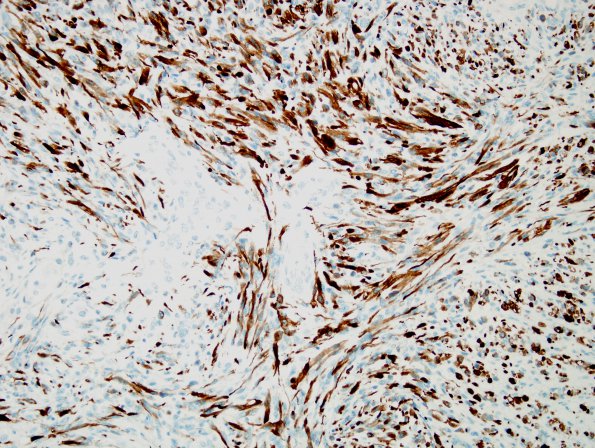 17E2 Meningioma, anaplastic (sarcomatoid) (Case 17) Desmin 3