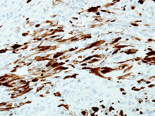 17E3 Meningioma, anaplastic (sarcomatoid) (Case 17) Desmin 2