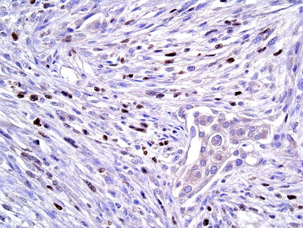 17F Meningioma, anaplastic (sarcomatoid) (Case 17) Myogenin 3.jpg