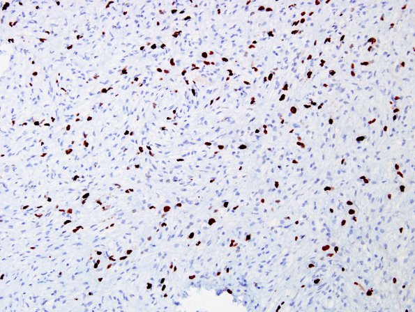 17G Meningioma, anaplastic (sarcomatoid) (Case 17) MIB 1