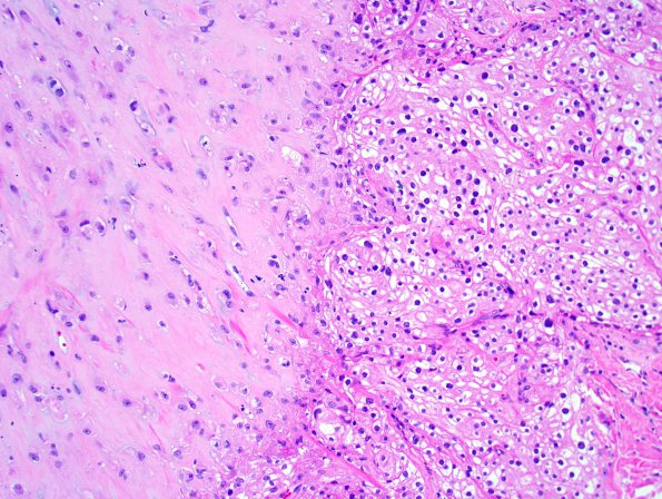 18A1 Meningioma, anaplastic (Case 18) 2.jpg