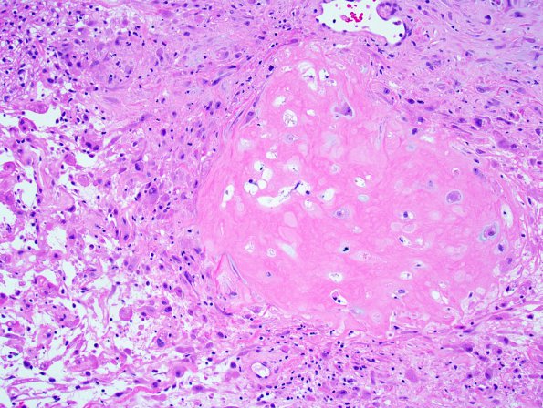 18A2 Meningioma, anaplastic (Case 18) 4.jpg