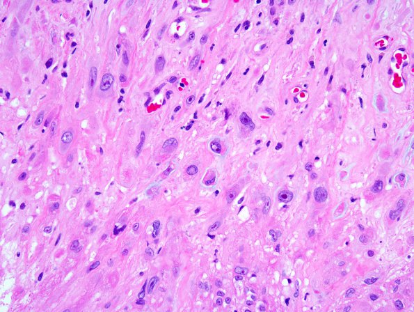 18A3 Meningioma, anaplastic (Case 18) 1.jpg