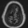 19A Meningioma, anaplastic (Case 19) FLAIR - Copy