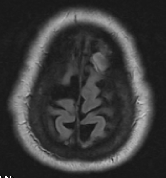 19A Meningioma, anaplastic (Case 19) FLAIR - Copy